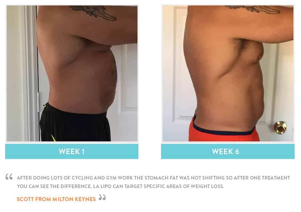 Before & After Stomach Fat Bricket Wood