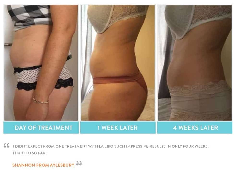 before, Cryolipolysis Bricket Wood