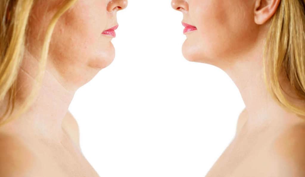 Double Chin treatment Bricket Wood before and after results