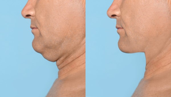 Which Non-Surgical Treatments Work Best for Jowls and Loose Skin Bricket Wood?