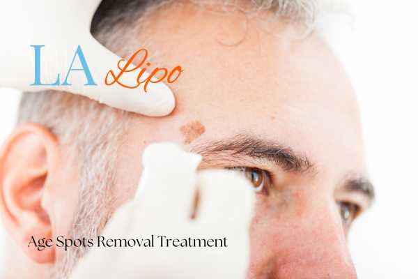 What Are the Most Effective Treatments for Age Spots Bricket Wood?