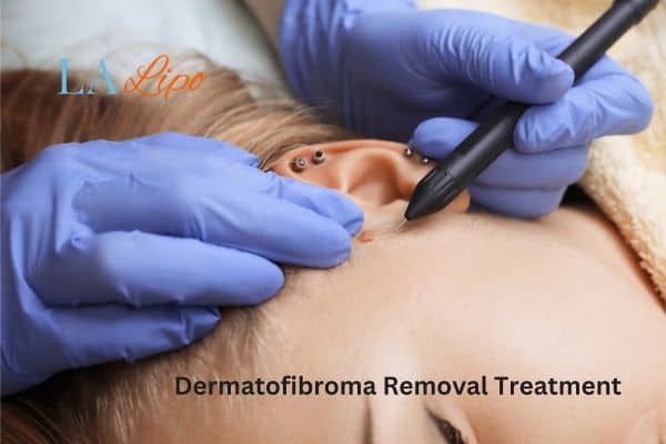 Dermatofibroma Removal Treatment Bricket Wood