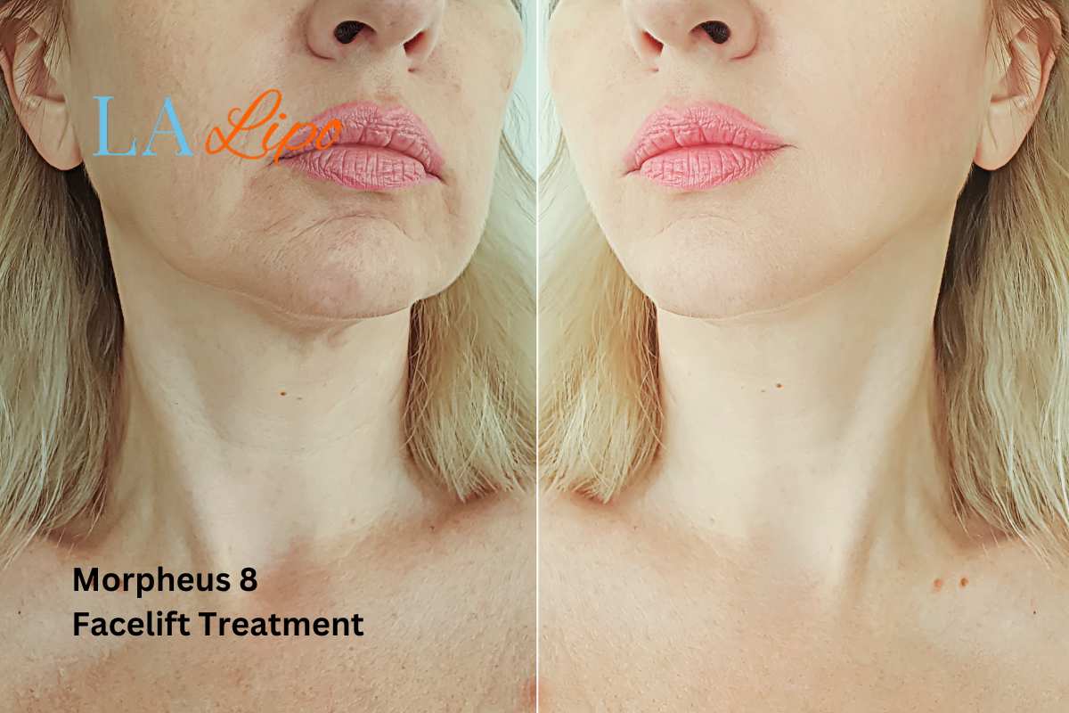 Turn back time with Morpheus8 Treatment Bricket Wood