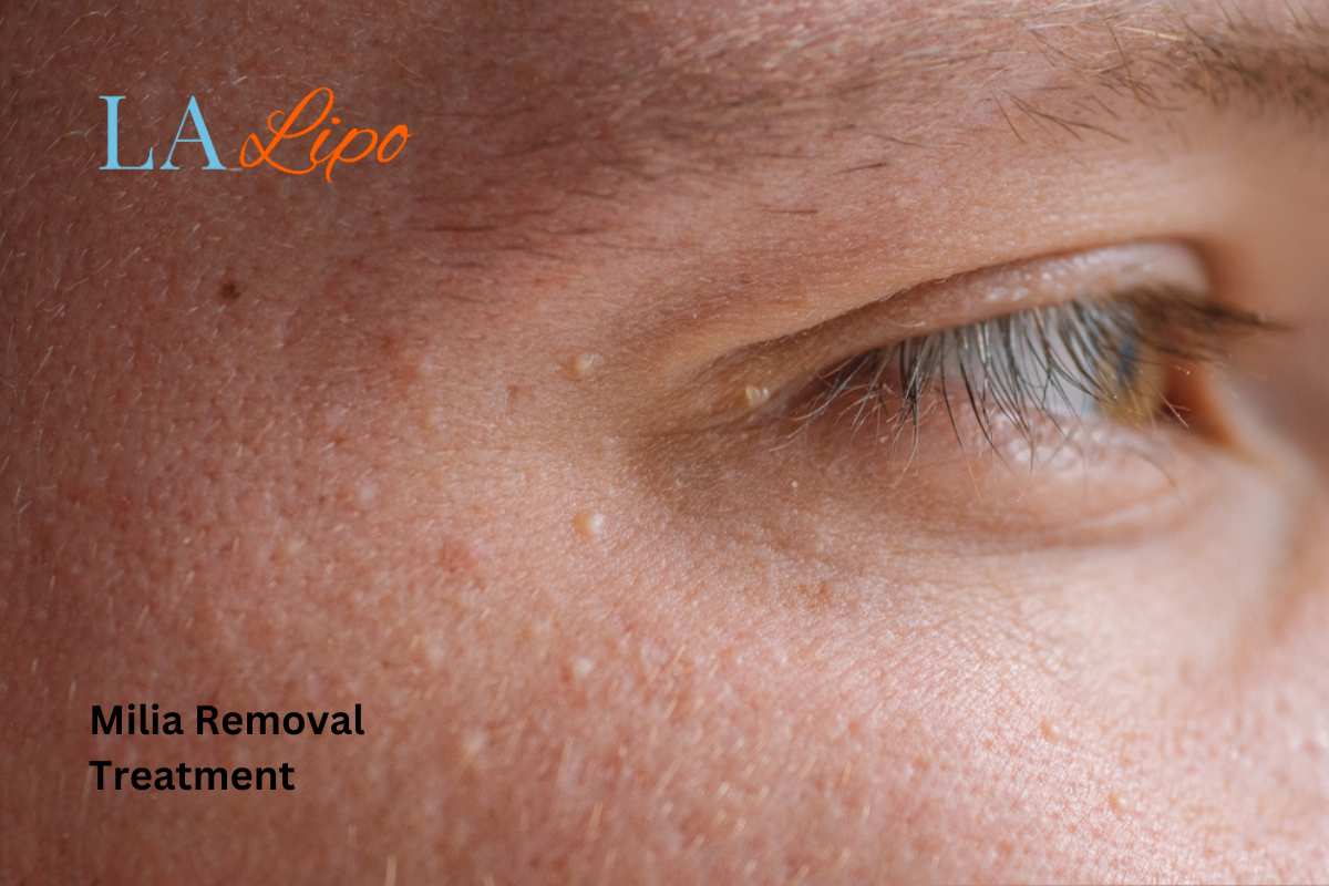 Cryopen Milia Removal: Is It the Easiest and Safest Option Bricket Wood?