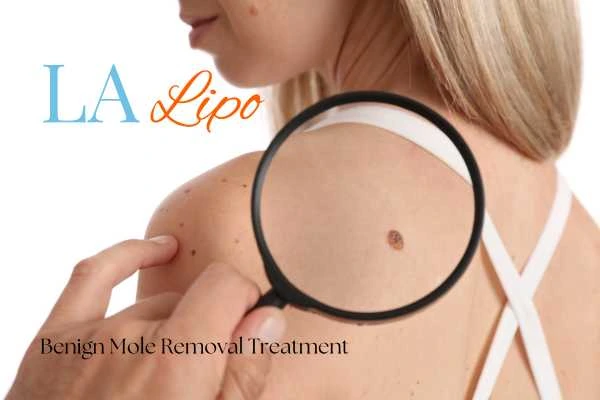 Why getting moles removed Bricket Wood can boost your confidence!