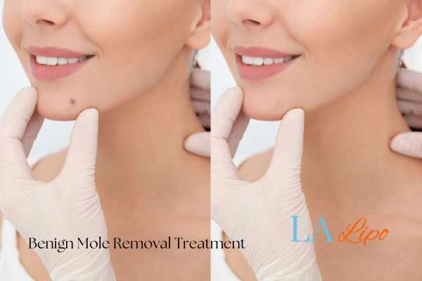 Woman's before and after results of being moles removal treatment Bricket Wood