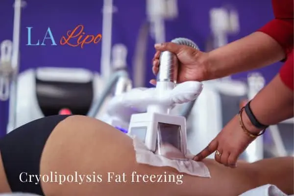 women getting fat freezing Bricket Wood