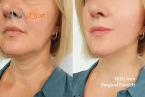 hi-fu for wrinkles Bricket Wood before and after results