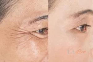 Before and after results of woman - HI-fu wrinkles reduction treatment Bricket Wood