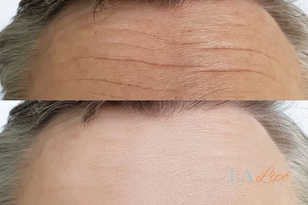 results of HIFU Bricket Wood on mans forehead to help reduce lines and wrinkles