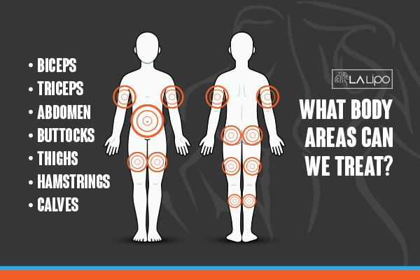 Graphic to show areas you can have LA-EMS Body Sculpting Bricket Wood treatment.