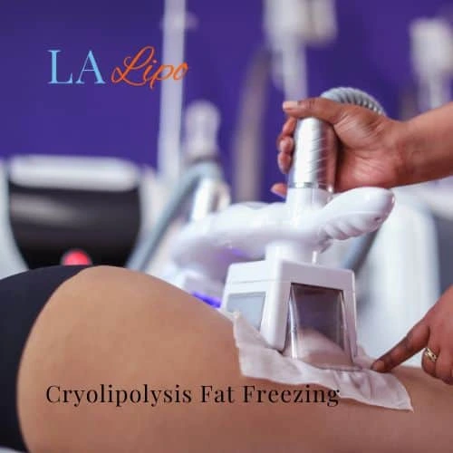 fat freezing - Cryolipolysis Bricket Wood