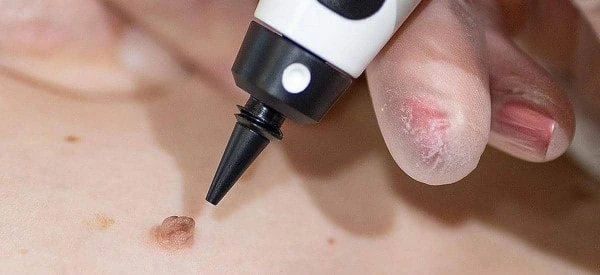 skin tag removal using cryopen Bricket Wood