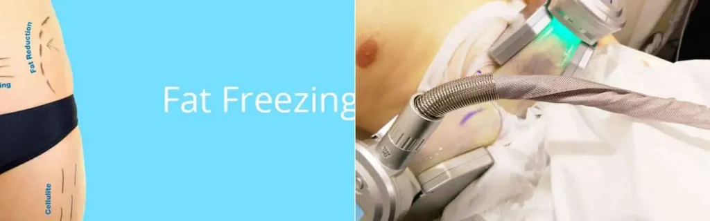 multi areas of a persons body having coolsculpting Bricket Wood treatment