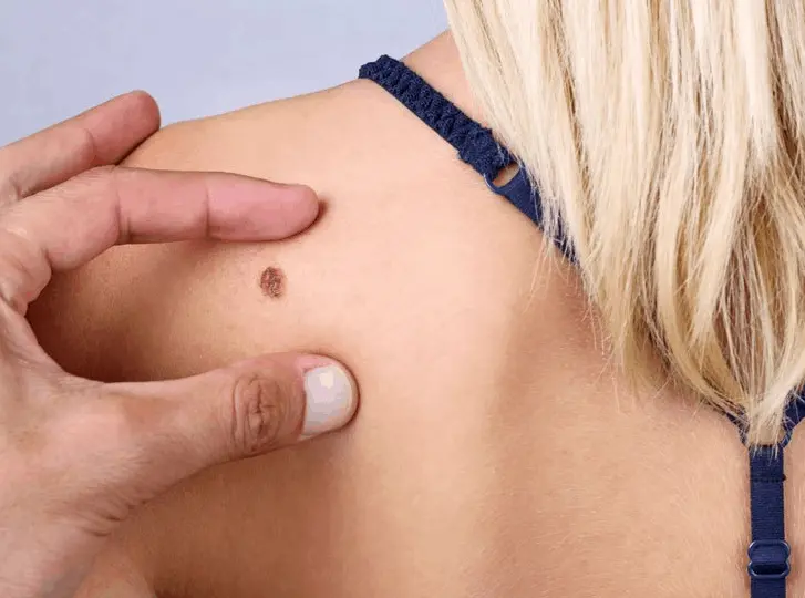woman having mole removal Bricket Wood consultation before treatment.
