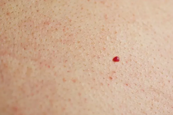 close up of a cherry angioma Bricket Wood