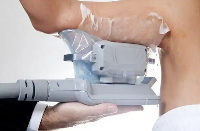 Picture of fat freezing Bricket Wood on the upper arms.