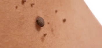 image of a skin tag Bricket Wood
