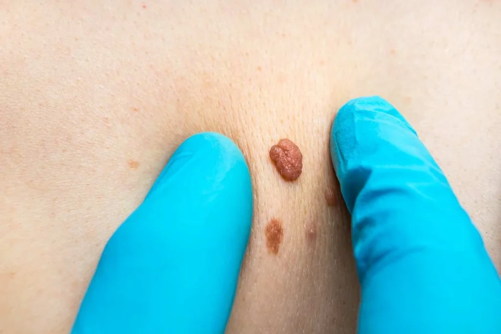 Consultant examining a skin tag Bricket Wood