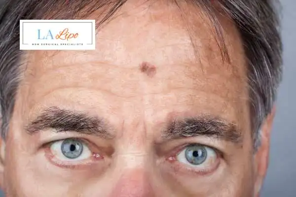 Solar Lentigo Removal Bricket Wood image of man with mark on his forehead