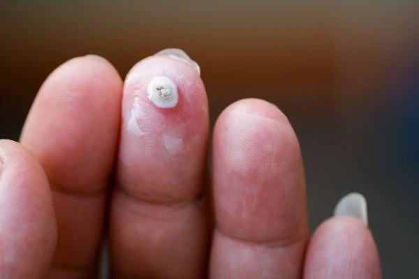 wart on person finger - cryotherapy to treat from LA LIPO Bricket Wood