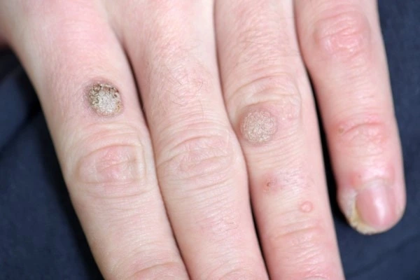 photo of warts on person hand - see wart removal Bricket Wood from LA LIPO