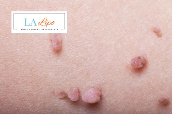Does cryopen skin tag removal Bricket Wood hurt? Find out now call our team today!