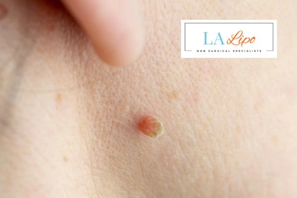 Book skin tag removal Bricket Wood today speak to our team now!