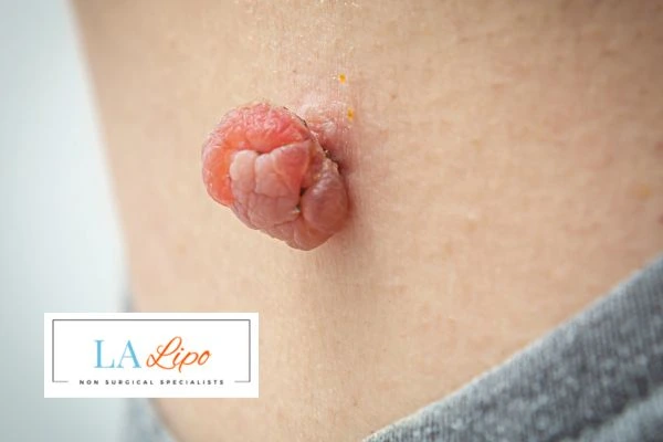 Interested in skin tag removal Bricket Wood? Concerned about the pain? Find out more today!