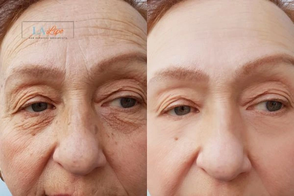 The powerful benefits of Morpheus8 Treatment Bricket Wood - Call Our team today!