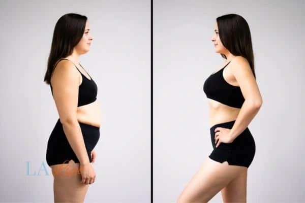 Picture of womans before and after using LA-EMS body sculpting to improve her core strength Bricket Wood