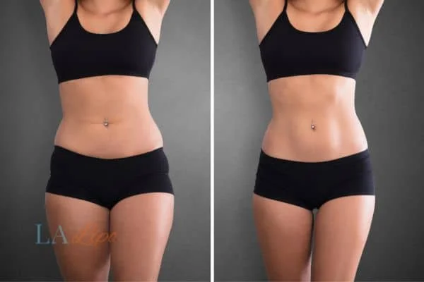 before and after results of non-surgical treatment to help a woman's body image and mental health Bricket Wood