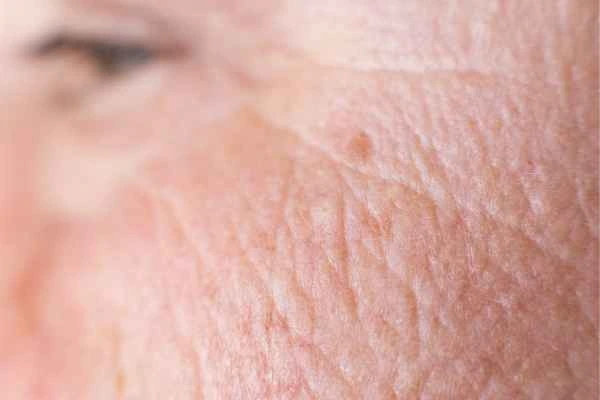 close up picture of a woman's face showing an age spot Bricket Wood
