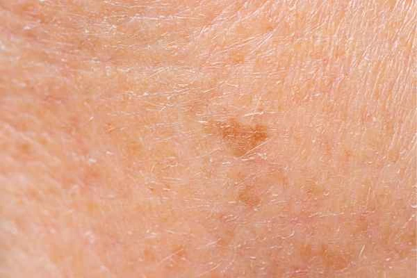 close up picture of age spots Bricket Wood