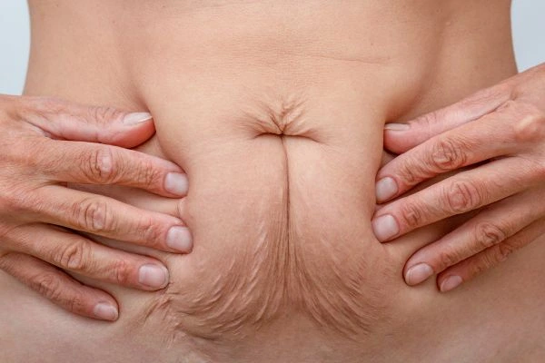 Image of a woman's stomach with loose skin - example of skin tightening Bricket Wood options