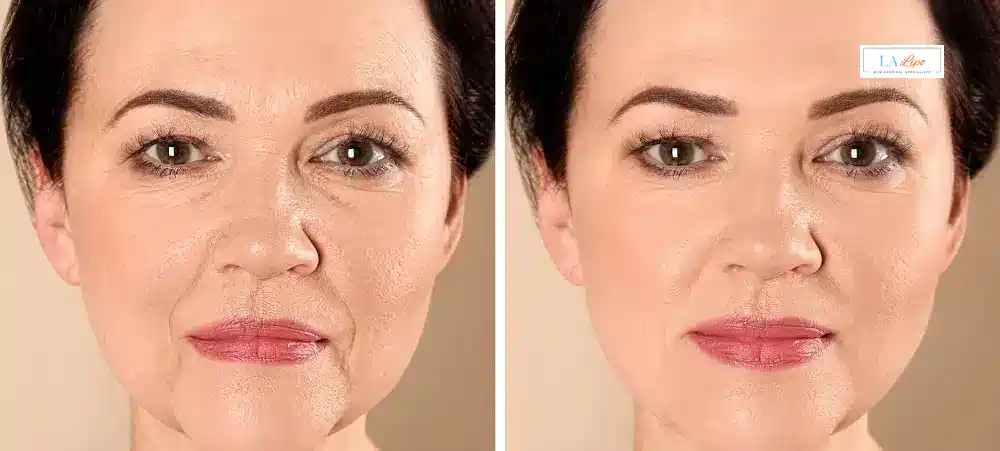 How Long Does It Take to See Results and How Long Do They Last Bricket Wood?