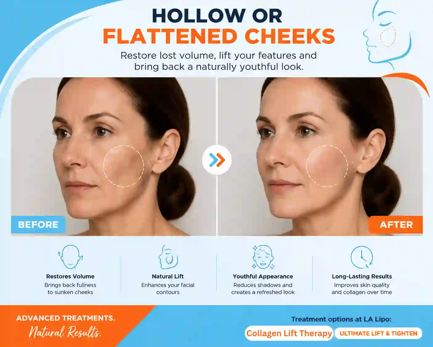 Sign #4: Hollow or Flattened Cheeks Bricket Wood