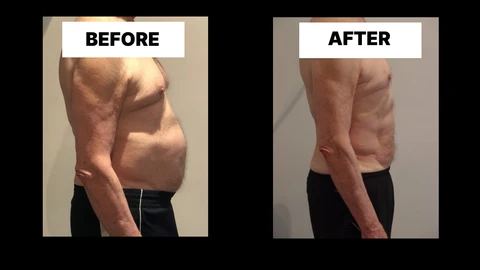 What Symptoms Can Diastasis Recti Cause in Men? Weak Core, Back Pain and Poor Posture Bricket Wood